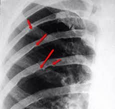 Above is the X-ray of a young patient suffering from a congenital narrowing of the aorta (coarctation of the aorta), with the characteristic rib notching. 

Coarctation of the aorta is a narrowing of the aorta distal to the ____________  artery
...