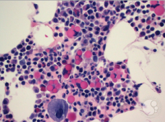 distended rER filled with immunoglobbulins in plasma cells