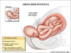 1. Normal birthing procedure fails to accomplish delivery
2. Prolonged head-to-body delivery time (>60s)
3. Difficulty with birth of face and chin
4. Baby’s head retracts against perineum (turtle sign)
5. Failure of baby’s head to restitut...