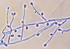 Saprophytic Septate Fungi (hyalohyphomycetes)


Cause: chronic mycetoma


-elliptical conidia supported by conidiophore ("lollipop")
-grayish-brown