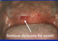 Oral cancer = most are squamous cell carcinoma from smoking and smokeless tobacco. Associated with low SES, alcohol and HPV. 
It is a firm lesion and may need to palpate, move tongue and remove dentures.