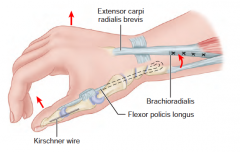 Restore pinch grip (typically for C6 quad) by tenodesing FPL and fusing IPJ; BR can extend wrist and tenodesis effect allows pinch grip. 

Usually combine with "Moberg Deltoid transfer" for C6 quad