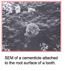• Cementicles are additional “blobs” of cementum that may be attached to the root surface, or found free in the PDL.  

•Thought to result from micro trauma which increases the loading on Sharpey’s fibres which in turn, tears the cemen...