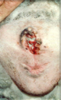 What does this image show? What can increase the prevalence of this? What can decrease prevalence?