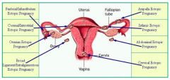- 95% occur in some portion of the fallopian tube
- 5% occur in other locations