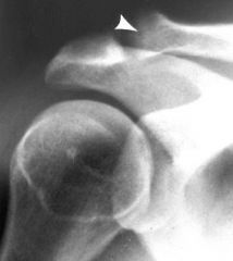 Hx:31yo professional bodybuilder c/o R shoulder pain w/ X-body add, pnt tend @ the AC jnt. xray Fig A, which treatment to provide the most successful result? 1-glenohumeral jnt injection; 2-periscapular mus strengthening; 3-labral repair; 4-SAS re...