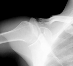 Osteolysis of the distal clavicle is one cause of shoulder pain p/acute injury or repetitive microtrauma. MC in wt-lifters.  SAS resection of the distal clavicle =to provide pain relief, return to function comparable to open techniques, the advant...