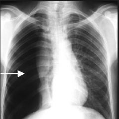 A patient comes in with a stab wound of the thoracic wall that has pierced the parietal pleura, & the parietal pleura has opened to outside air. 

Patient is diagnosed with an open pneumothorax. 

The X ray of the anterior thoracic wall is sho...
