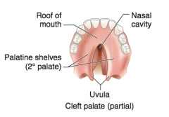 - Failure of fusion of the two lateral palatine processes 
OR
- Failure of fusion of lateral palatine processes with the nasal septum and/or median palatine process (formation of 2° palate)