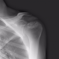 Hx:37yo severe asthmatic has been taking daily corticosteroids for 20  yrs, now c/o 4 mths of worsening L shoulder pain, unable to complete a full day of work 2^to the pain. xray Fig A. Which of the following describes the pathogenesis behind this...