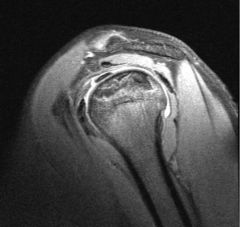radiograph demonstrates AVN of the humeral head and early collapse of the articular surface, 65 shoulders with AVN of the humeral head reporting mixed results with 35 shoulders requiring arthroplasty after failure of conservative therapies. Surgic...