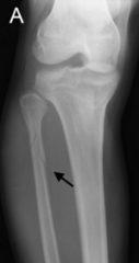 Rmbr, how the sciatic nerve injury leads to foot drop? 

Injury of a fracture at this above on the fibula(what is this site?) will cause injury to WHAT nerve--the result also being foot drop
