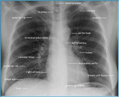 mediastinum
trachea
cardiac silhouette
lung hili
costophrenic angles
diaphram
lung parenchyma
bone