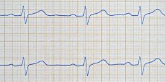 Vad visar EKG:et? 