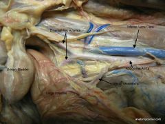  External iliac arteries
IVC (blue)

Abdominal Aorta

Inferior Mesenteric (connects to large 
intestine)