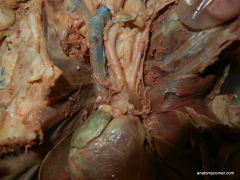     identify
- Brachiocephalic vein
- Brachiocephalic artery
- Left Subclavian Artery
- Aortic Arch