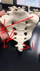 1. Coccyx
2. Anterior sacral foramina
3. Alae