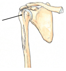 between the greater and lesser tubercles of the proximal humerus 