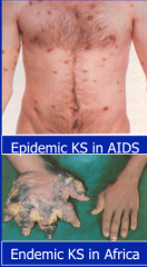raised reddish lesions are angioproliferative tumors occurring in AIDS patients reflecting infections with HHV 8. Variants:
- epidemic (AIDS)
- classic (elderly mediterranean men)
- endemic (sub Saharan Africa)