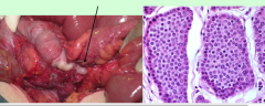 What is shown here?
Common/uncommon?
What tumor type? 
Benign/malignant?
What part of appendix?