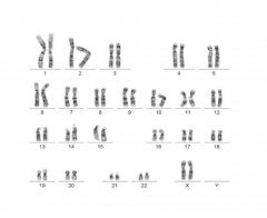 Kromosompar opstillet i et skema efter størrelse.
Et individs eller en celles kromosombesætning.