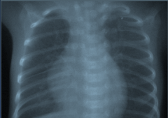 A baby delivered by a caesarean section presents with respiratory distress. This is his radiograph. What is the most likely diagnosis ?