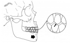 Mesial aspect of the mandibular posterior teeth and the distal aspect of the maxillary teeth