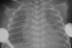 This radiograph is from a newborn with signs of respiratory distress. What is the most likely diagnosis ?