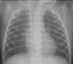 Comment on the lung volume of the following radiograph.