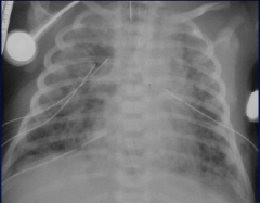 A neonate presents with respiratory distress. This is the radiograph. What is the most likely diagnosis ?