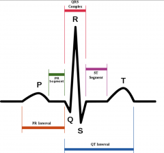 ST Elevation


---------------------


- EKG/ECG (monitors electrical activity of Heart)


- P.A (cardiac chest pain at rest)


- cause: vasospasm


 