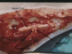 cervical spine-dorsal laminectomy or ventral spondylectomy (aka slot)
thoracolumbar spine-dorsal laminectomy or hemilaminectomy