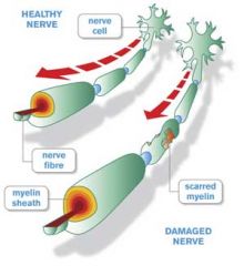 Demyelination and degeneration of myelin and axons in nerve roots
