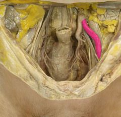 What is the structure highlighted in pink? What structure does it change into as it passes deep to the inguinal ligament?