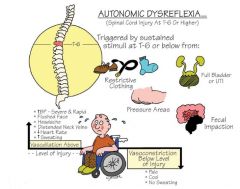 Autonomic dysreflexia