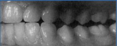 Cuspid on the laterotrusive side guides the mandible and disoccludes the posterior teeth in laterotrusive movement (Christensen's phenomenon) is called?

This is coupled with?