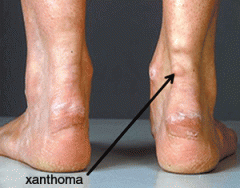 Achilles tendon xanthoma