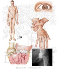 Arachnodactyly, lens dislocation, aortic dissection, hyperflexible joints
