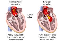 Aortic regurgitation