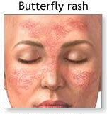 “Butterfly” facial rash and Raynaud phenomenon in a young female