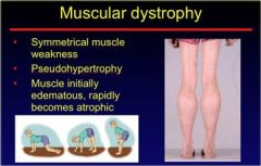 Muscular dystrophy (most commonly Duchenne): X-linked recessive deletion of dystrophin gene