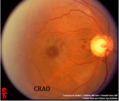 “Cherry-red spots” on macula