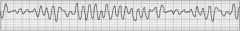 While assessing a middle-aged man who complains of nausea and weakness, he suddenly becomes unresponsive. The cardiac monitor displays the rhythm shown below. After determining that he is apneic and pulseless, you should: