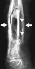 (CRP) should peak by 48 hrs p/ surgical fixation of bony orthopedic injuries, and decrease thereafter. an increasing CRP p/ 48 hrs is predictive for postop infection, and is more predictive in the first postoperative week than local erythema, pers...