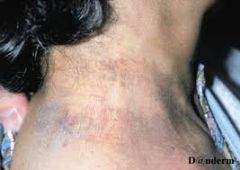 75 year old woman with long history of RA comes in for a progressive 'rash' on her neck that started to appear after she went to the beach.   What other dermatologic manifestations should you be concerned about?