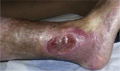 Hydroxyurea can induce leg ulcers