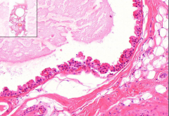 Breast
- Massive fibrosis
- Large and small cysts (of ducts)
- Apocrine metaplasia: Inner lining of cyst
- Secretion of some proteinaceous material (milk) but low amount - the gland is not lactating
- May see scarring, cysts and calcification...