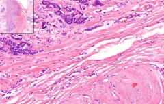 Breast
- Violet area = tumor
- Form ducts with cribriform pattern
- May form islands (solid type) - cohesive

Risk factors?
Macro?
Micro types of this?
Metastasis?
Treatment?

Carcinoma in situ lesions?