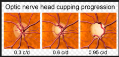 Abnormal cup to disc ratio from glaucoma. Normal ratio is cup is no more than 30% of ratio. As aqueous humor builds up, ratio increases, can lead to blindness. Must stop production of aqueous humor. Use acetozolamyde, latonoprost, betablockers, pi...