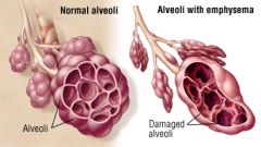 A respiratory disorder characterized by an overinflation of the alveoli.